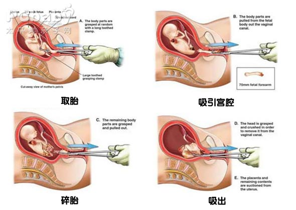 打胎的过程图片