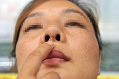 女子隆鼻两年后假体穿出鼻梁歪脓水流图