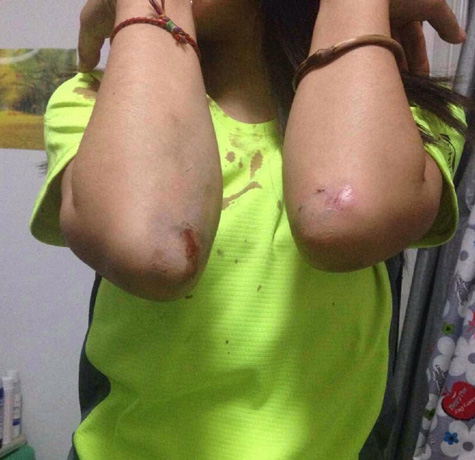 北京一女子夜跑遭抢劫殴打衣服全是血已报警立案