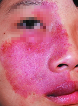 小心红胎记是祸不是福