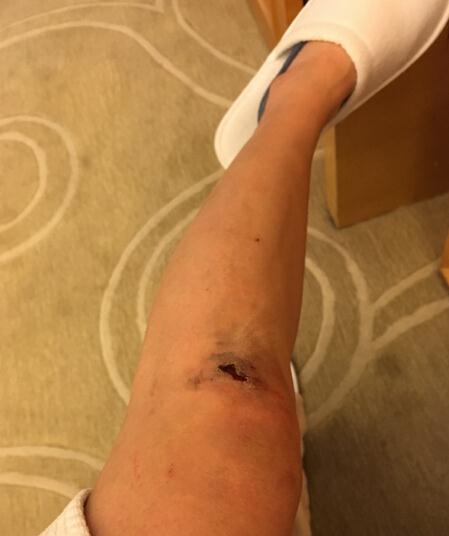 3月22日早上5点多,李念就发了微博,她晒出一张膝盖受伤的照片,并配文