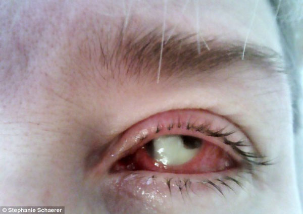 女子戴视康隐形眼镜一天后感染被迫摘除眼球