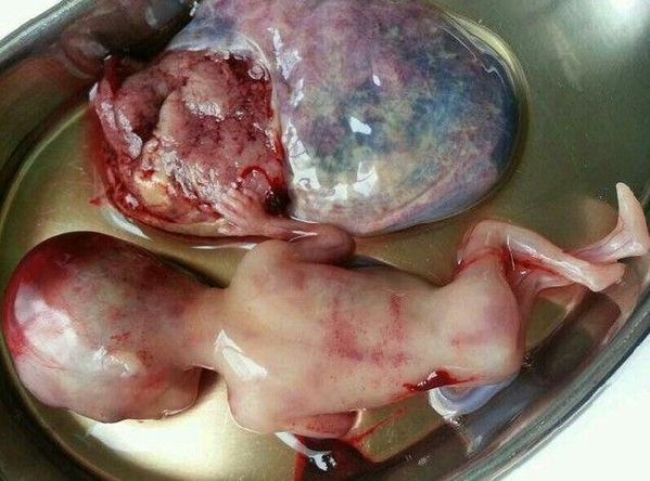 六个月堕胎的胎儿图片图片