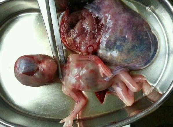 原图·· 血淋淋的堕胎照片,看了你还忍心堕胎吗?