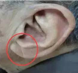 图中耳垂上有冠状沟的患者