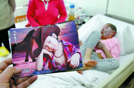 玻璃瓶装硫酸放楼道 郑州7龄童用"水"洗手被毁容