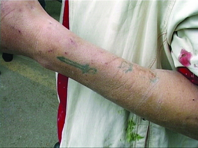 男子左臂有针眼.获救的两个小姑娘.